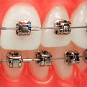 Orthodontist in Monrovia | Orthodontics Braces to Prevent Crooked Teeth